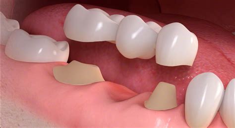 Dental Bridges .